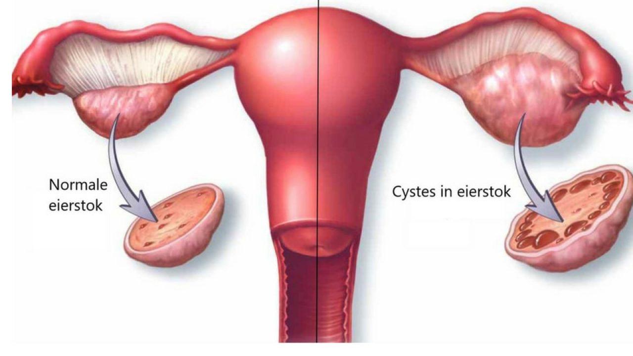 PCOS uitleg