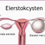 Eierstokcysten SHE Health Clinics