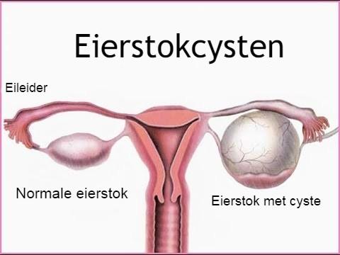 Eierstokcysten SHE Health Clinics