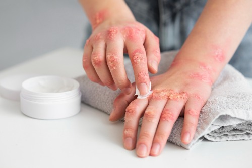 Psoriasis handen SHE Health Clinics